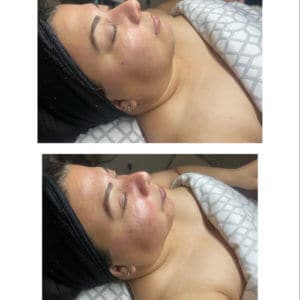 Facial cupping | Luminous Skin Care Studio in Santa Clara, CA
