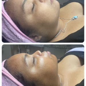 Lymphatic drainage of the women face and neck before and after Treatment | Luminous Skin Care Studio in Santa Clara, CA