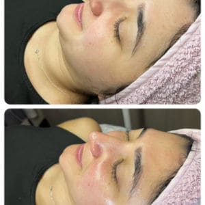 Luminous Signature Facial with Dermaplaning before and after Treatment | Luminous Skin Care Studio in Santa Clara, CA