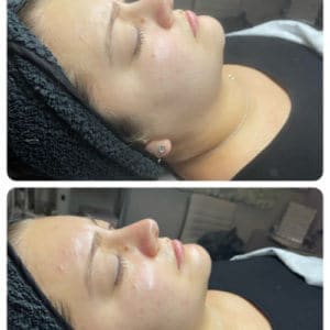 Luminous Signature Facial with Dermaplaning before and after Treatment | Luminous Skin Care Studio in Santa Clara, CA