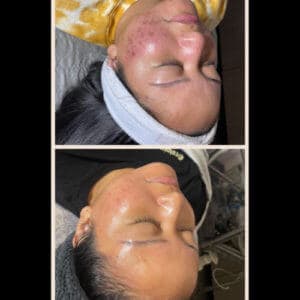 Acne on the women face before and after Treatment | Luminous Skin Care Studio in Santa Clara, CA