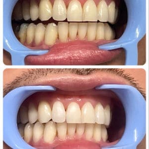 Touch up 30 min Treatment Before and After Photos | Luminous Skin Care Studio in Santa Clara, CA