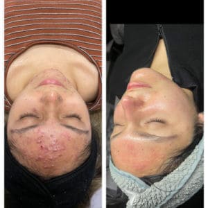 Acne treatment Before and After Photos | Luminous Skin Care Studio in Santa Clara, CA