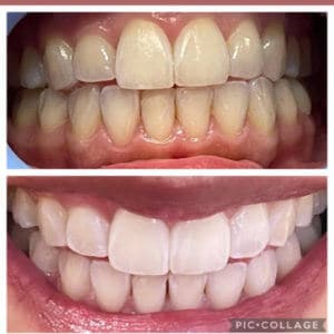 Teeth whitening before and after Treatment | Luminous Skin Care Studio in Santa Clara, CA