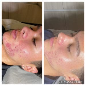 Acne face before and after Treatment | Luminous Skin Care Studio in Santa Clara, CA