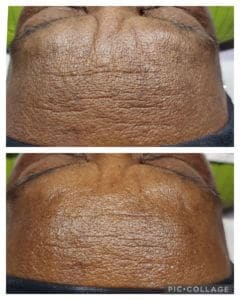 Anti-aging Treatment Before and After Photos | Luminous Skin Care Studio in Santa Clara, CA