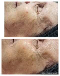 Anti-aging Treatment Before and After Photos | Luminous Skin Care Studio in Santa Clara, CA