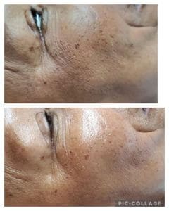 Anti-aging Treatment Before and After Photos | Luminous Skin Care Studio in Santa Clara, CA