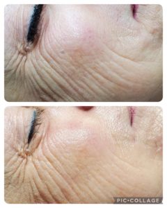 Anti-aging Treatment Before and After Photos | Luminous Skin Care Studio in Santa Clara, CA