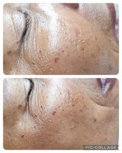 Anti-aging Treatment Before and After Photos | Luminous Skin Care Studio in Santa Clara, CA