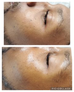 Hydrofacial before and after Treatment | Luminous Skin Care Studio in Santa Clara, CA